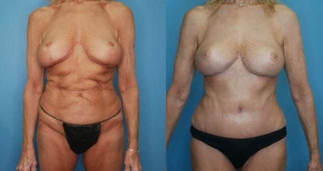 Mommy Makeover Landing Page