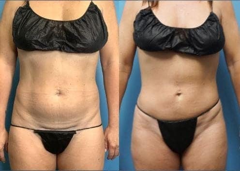 VASER Liposuction Landing Page