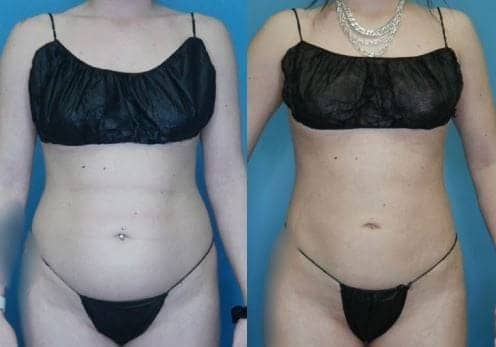 VASER Liposuction Landing Page