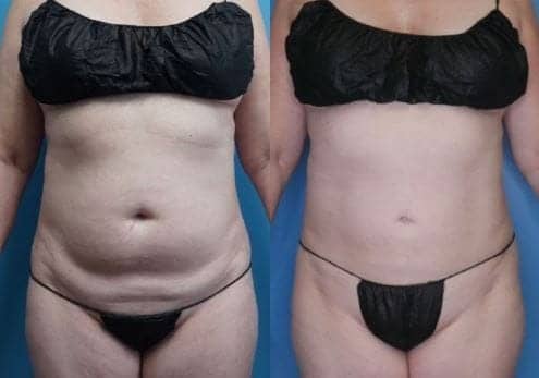 VASER Liposuction Landing Page