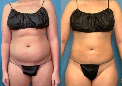 VASER Liposuction Landing Page