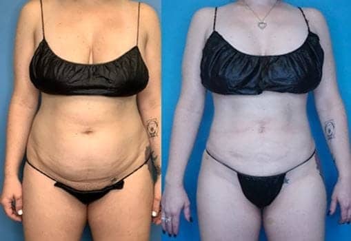 VASER Liposuction Landing Page